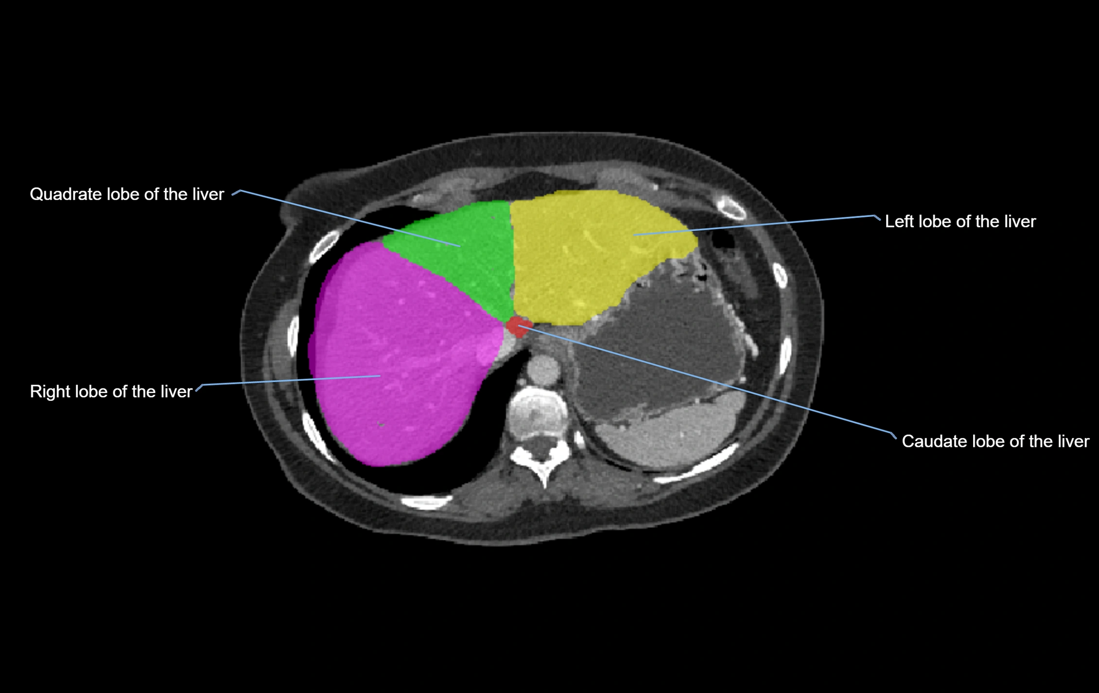 CT lliver lobes axial cross sectional anatomy labelled image -00063.webp